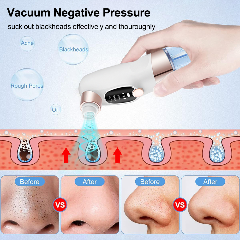 Electric Blackhead Remover Vac – обзор и цена Pore Vacuum