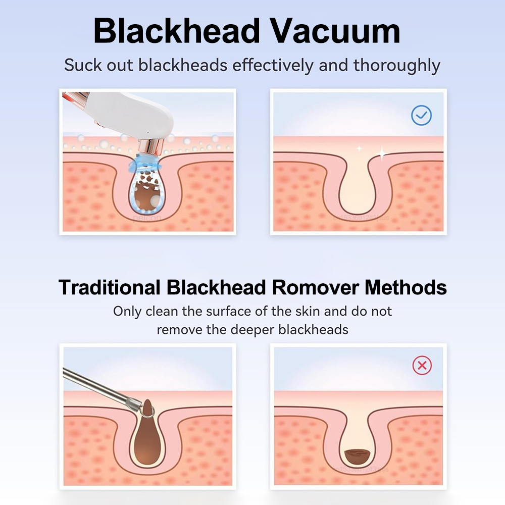 Electric Blackhead Remover Vac – обзор и цена Pore Vacuum