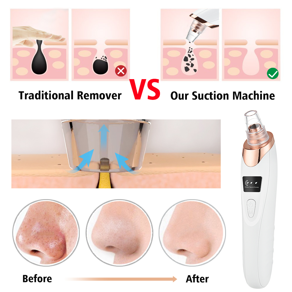 Blackhead Remover Vacuum Pore  – обзор и цена Pore Vacuum